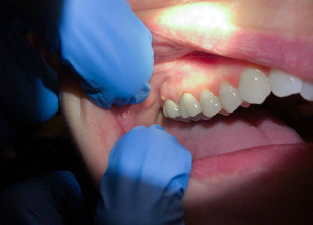 Best Emergency Treatment for Toothache in Moorestown Lenola, NJ